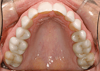 tooth colored restorations